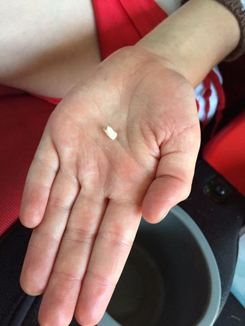 First Tooth Lost June 13, 2015, Age 4